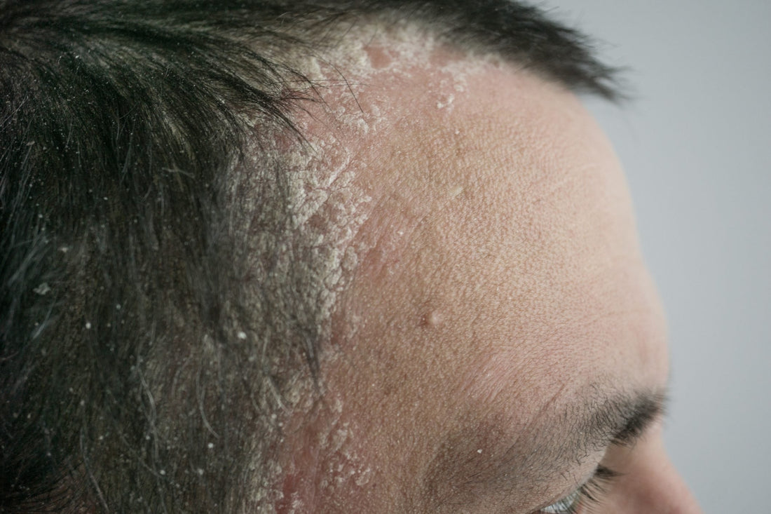 Understanding Psoriasis: Its Impact on Hair, Scalp, and Emotional Well-being