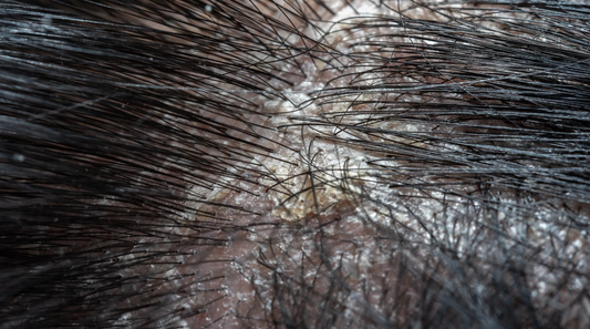 Decoding Scalp Health: Dry Scalp vs. Inflammatory Conditions